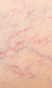 Do Spider Veins Come Back After Laser Treatment? | Vein Treatment California