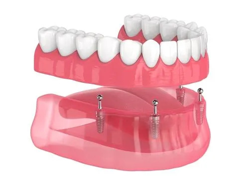 What Role Does Precision Play in Implant Denture Placement?