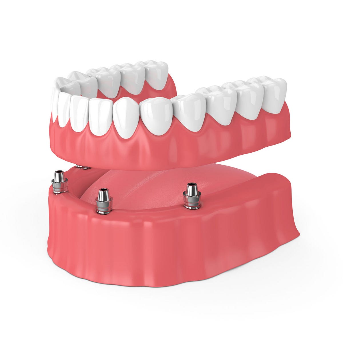 Can Dental Implants Improve Your Quality of Life? Examining the Benefits