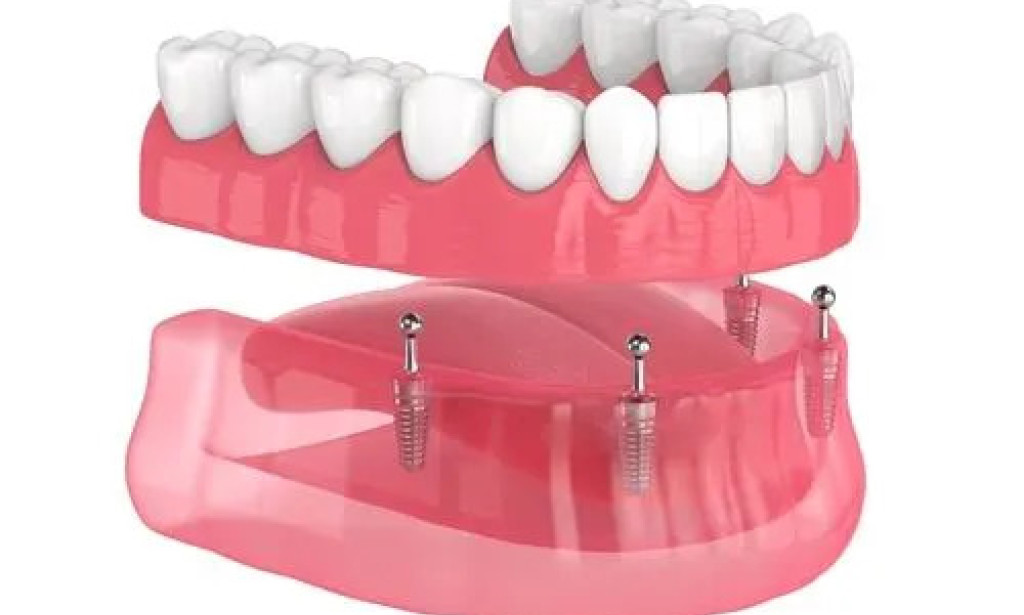 The Ultimate Guide to Implant Dentures: Top Dentist Tips