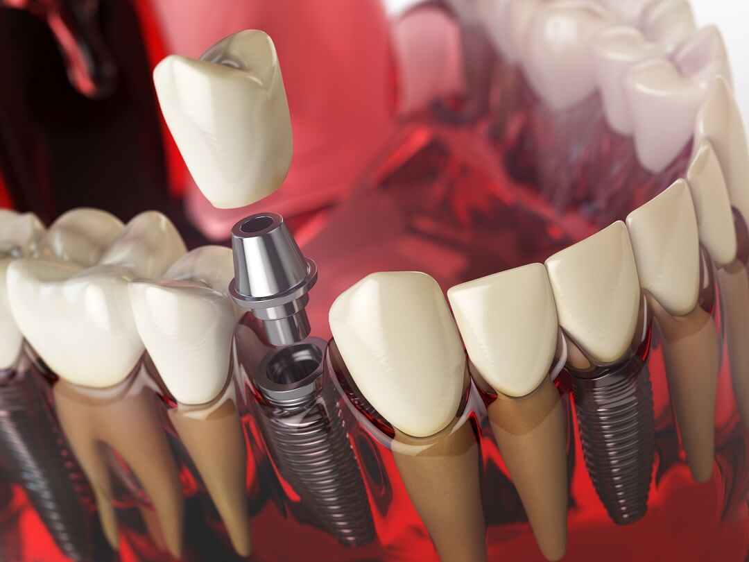 Dental Implants in Rajkot: Restoring Your Smile with Confidence