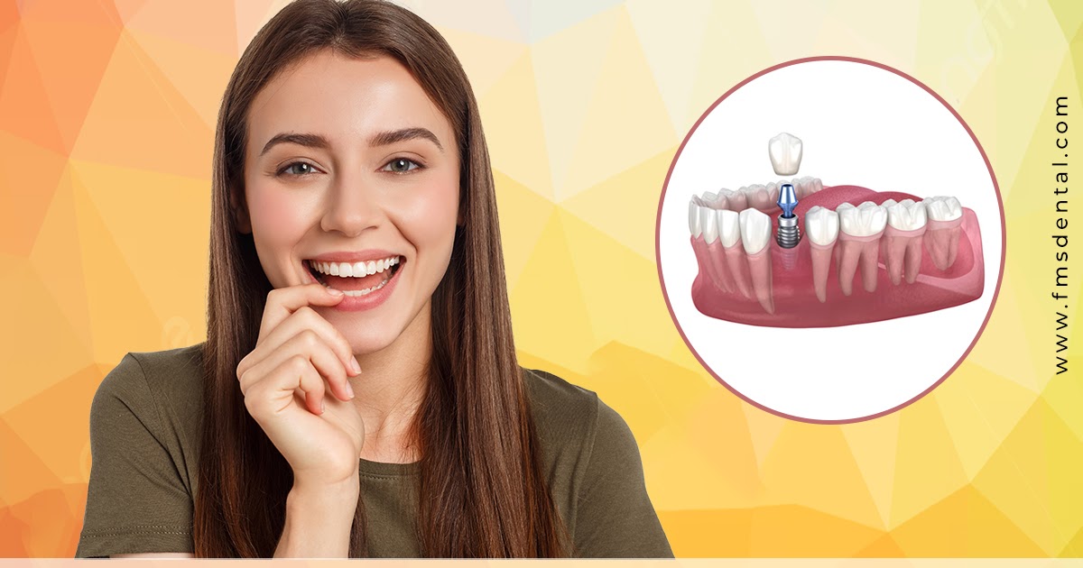 Single-piece Dental Implants vs Two-piece Dental Implants