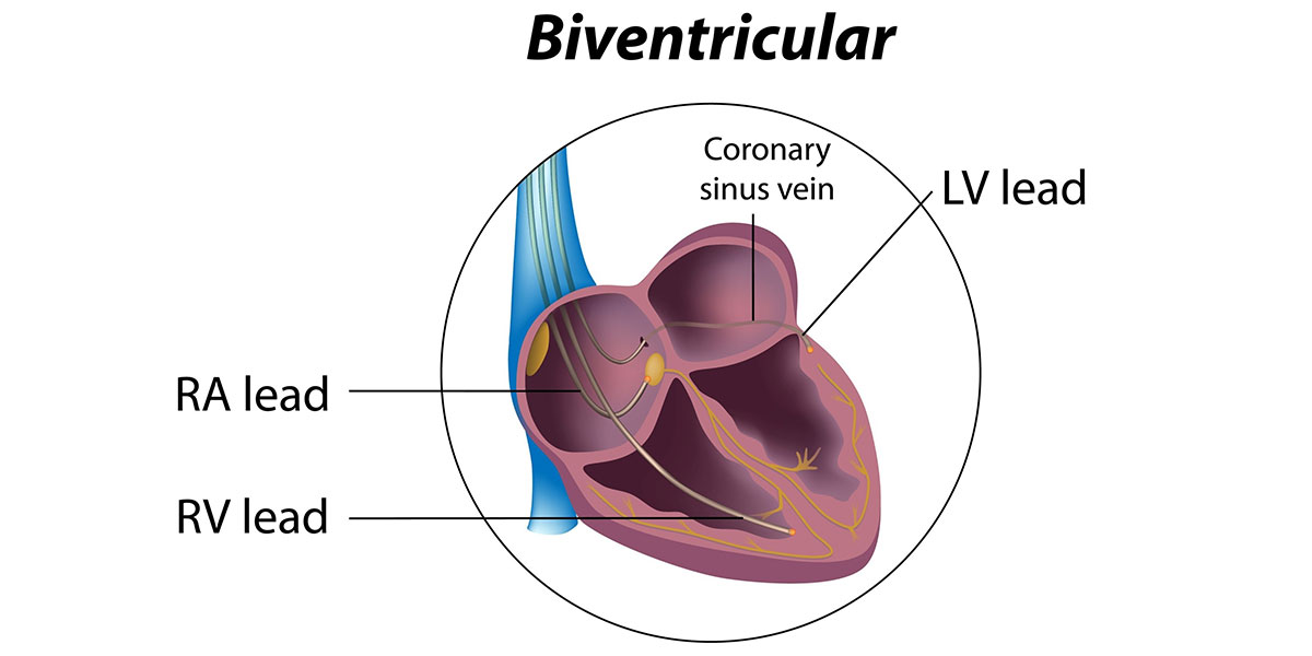Cardiac Resynchronization Therapy: Benefits & Procedure