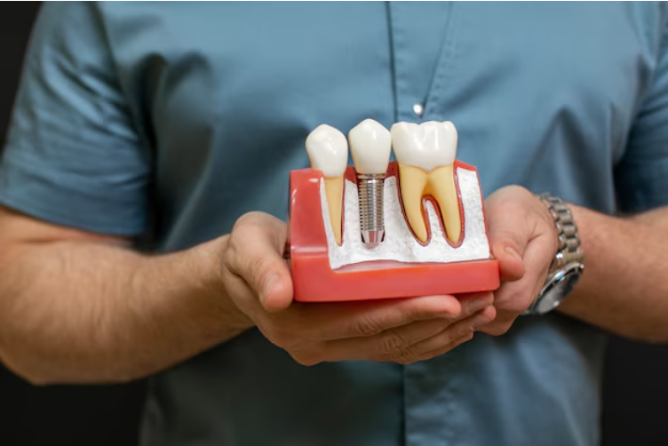 How Dental Implants Work: Step-by-Step Process Explained - AlRigga