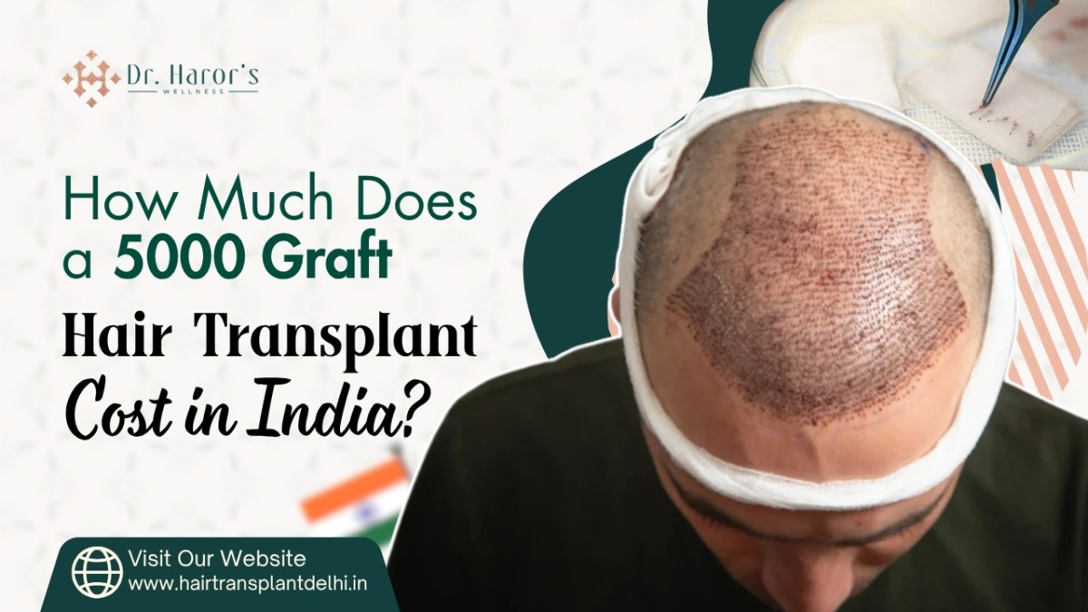 How Much Does a 5000 Graft Hair Transplant Cost in India? – Best Hair Transplant Clinic in Delhi, India