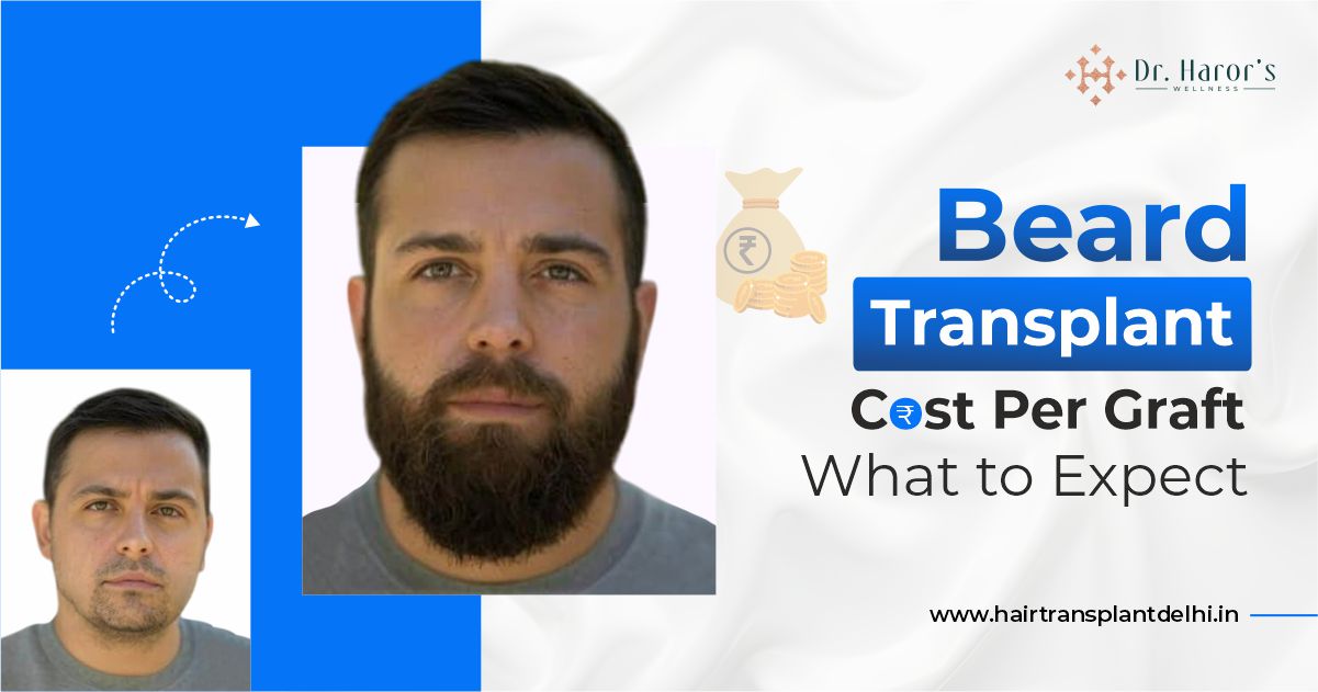 What Factors Decide Beard Transplant Cost? A Complete Guide – Best Hair Transplant Clinic in Delhi, India