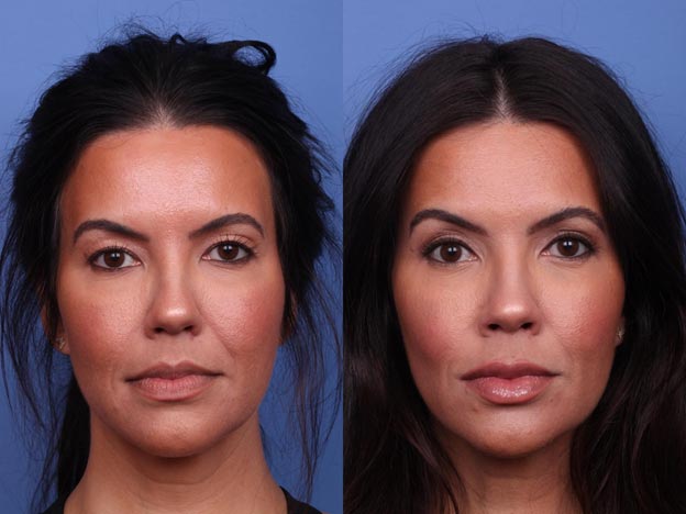 Eyelid Surgery Cost Cape Town: What’s Included