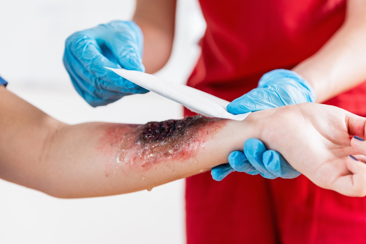 Springfield Car Accident Lawyer for Burn Injury Compensation