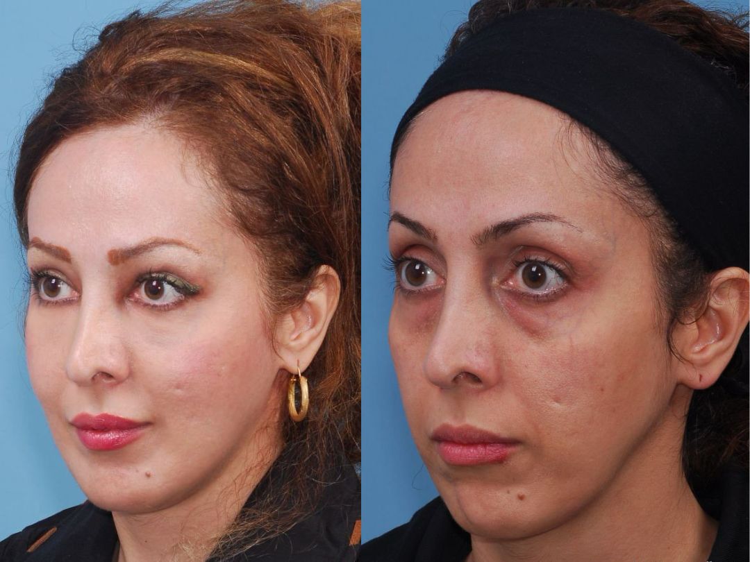 UAE Full Face Fat Transfer | Blue Angel Poly Clinic