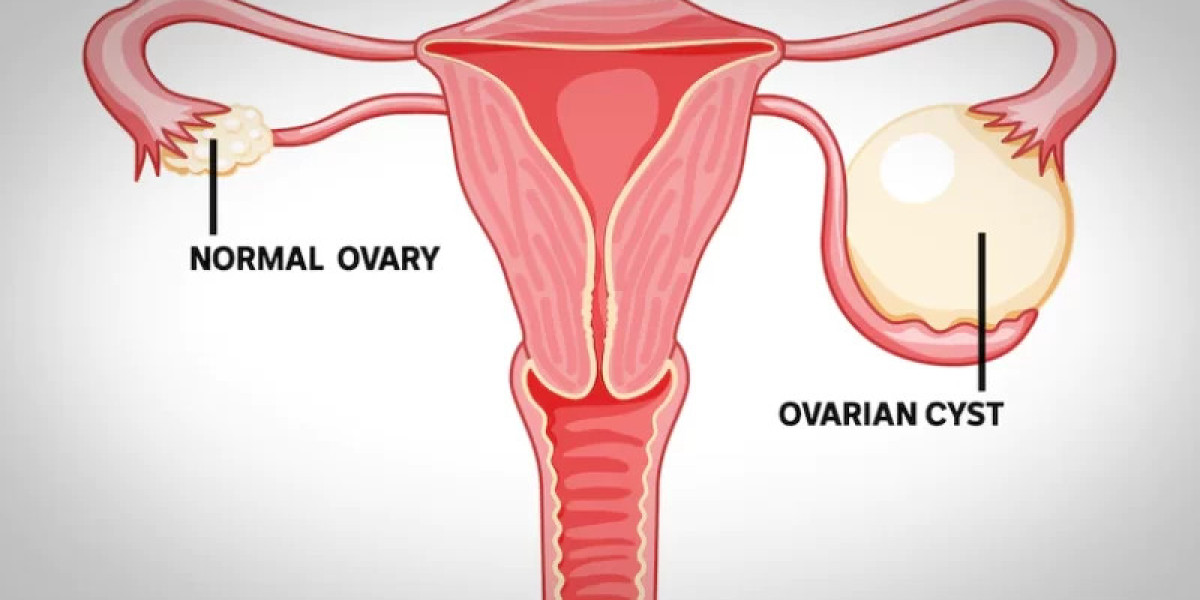 Uterus Removal Surgery in Gurgaon
