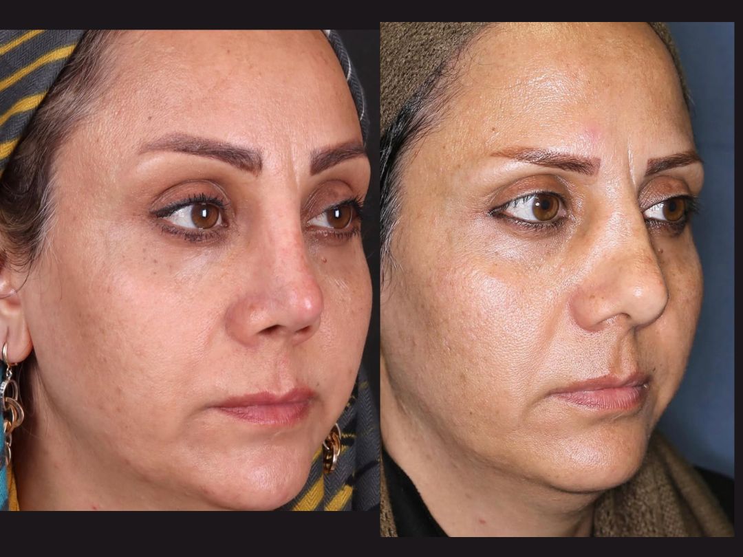 Rhinoplasty Dubai | Best Rhinoplasty | Blue Angel Poly Clinic