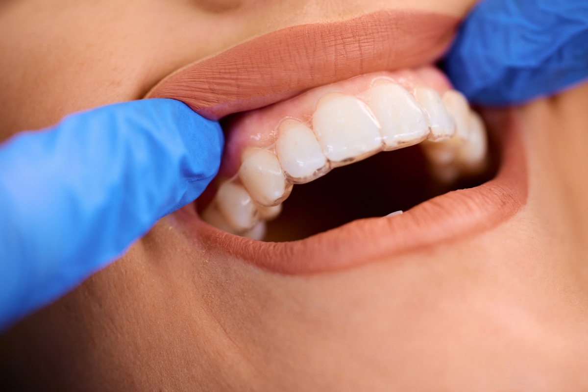 Thinking About Straightening Your Teeth Start Here With Invisalign Treatment