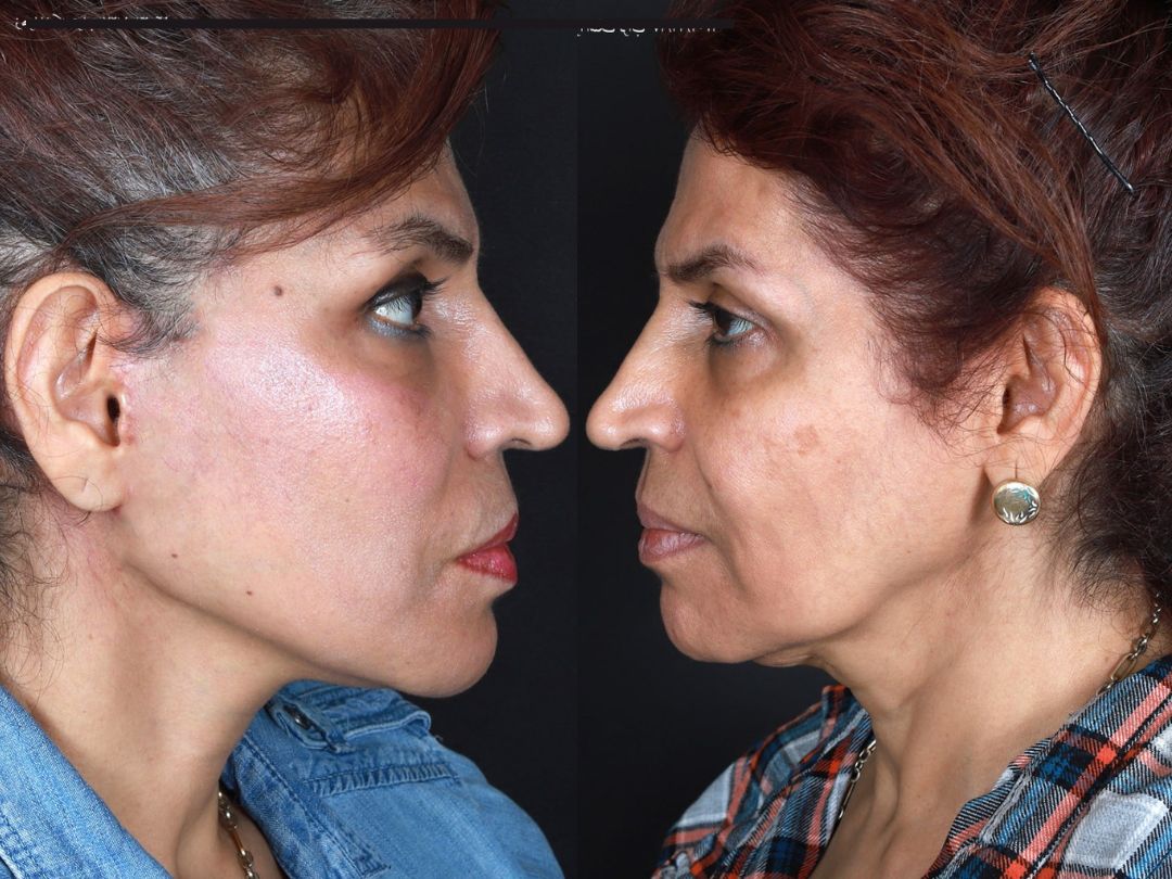 Deep Plane Facelift | Facelift Surgery UAE | Blue Angel Poly Clinic