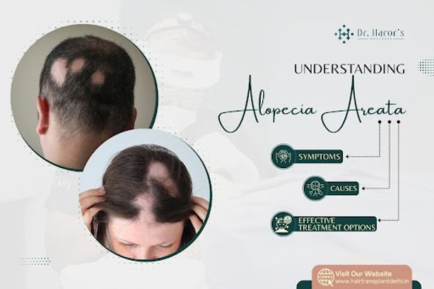 Alopecia Areata Treatment: Causes, Symptoms and Best Hair Regrowth Options