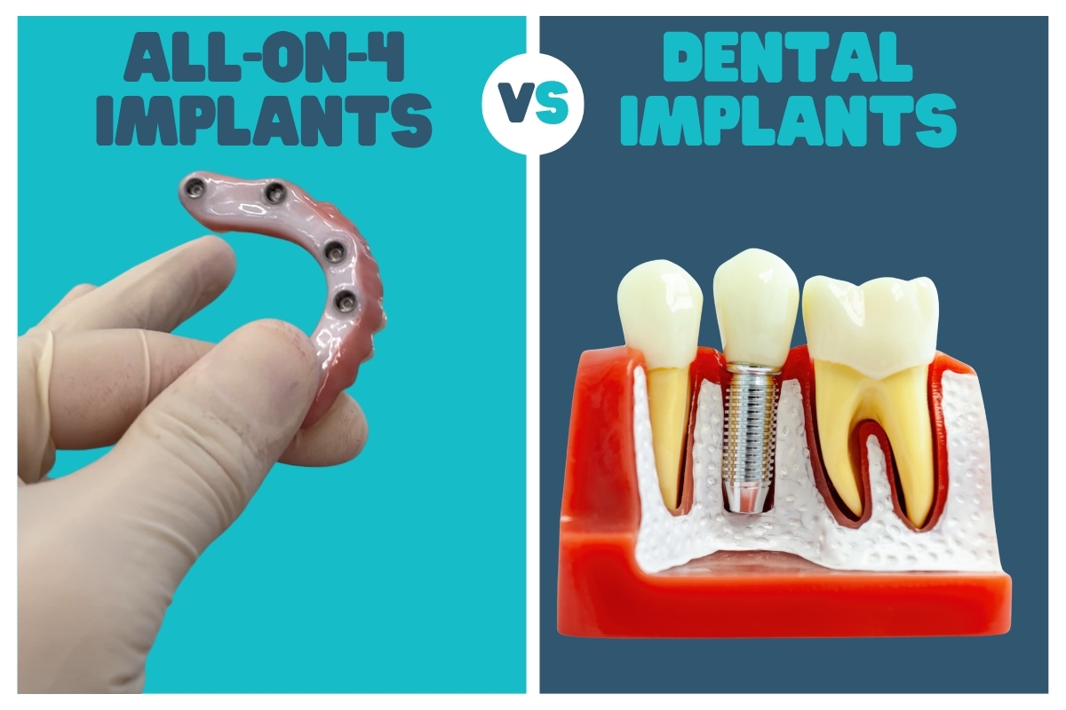 All-on-4 Implants vs Regular Dental Implants A Complete Comparison Guide