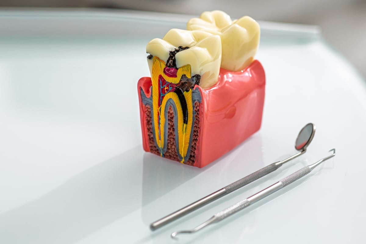 Taking the Fear Out of Root Canals Expert Care in New Lenox