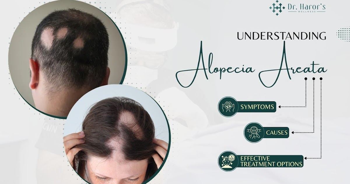 Understanding Alopecia Areata: Symptoms, Causes and Effective Treatment Options